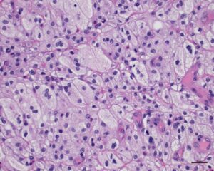 Figure 2: Photomicrograph of a histologic section of an oral cavity xanthoma that was surgically excised from a cat. Note sheets of foamy (lipid-laden) macrophages (thin black arrows) and fewer lipid-laden multinucleated giant cells (thick black arrows). H&E stain. Photo courtesy of Dr. Pam Mouser, Angell Pathology