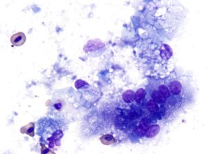 Figure 3: Photomicrograph of a fine needle aspirate from a subcutaneous mass on the wing of female green-winged macaw. Note lipogranulomatous inflammation consisting of lipid-laden macrophages (thin black arrows), multinucleated giant cell (thick black arrow), and a heterophil (red arrow). Angular plates representing cholesterol crystals (green arrows) and clear vacuoles representing free lipid are present in the background. 1000x magnification, Wright-Giemsa stain