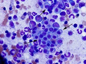 Figure 1: Bone marrow cytology from a 10 year old dog with multiple myeloma. Note clusters of plasma cells (black arrows) among the hematopoietic precursors. 500x magnification, Wright-Giemsa stain.