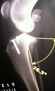 Image 2: Three months later, the tibial plateau angle is less than 14 degrees, and clinical lameness has resolved.