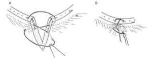 Figure 4.  Figure of 8 suture pattern for closure of the V-plasty
